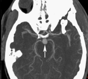 知名男歌手臺上高歌致腦出血不幸離世!這類人唱歌千萬要小心(圖3) 知名男歌手臺上高歌致腦出血不幸離世!這類人唱歌千萬要小心