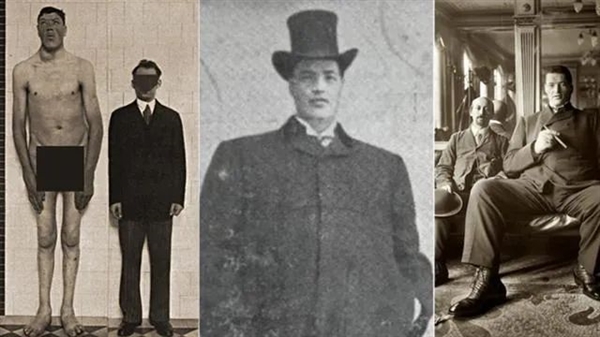 全世界唯一的侏儒巨人：18歲才1.4米 最終卻長到2.34米！